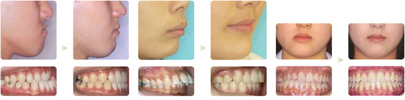 あごの手術を伴う矯正治療 外科的矯正治療 大矢矯正歯科 加古川 明石の歯列矯正専門歯科医院